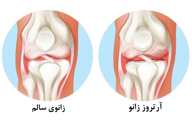 نکات مهم و پیشگیری از آرتروز زانو