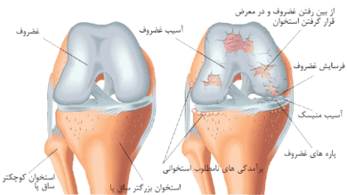 آرتروز زانو (Osteoarthritis of the Knee)