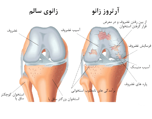 آرتروز زانو (Osteoarthritis of the Knee)